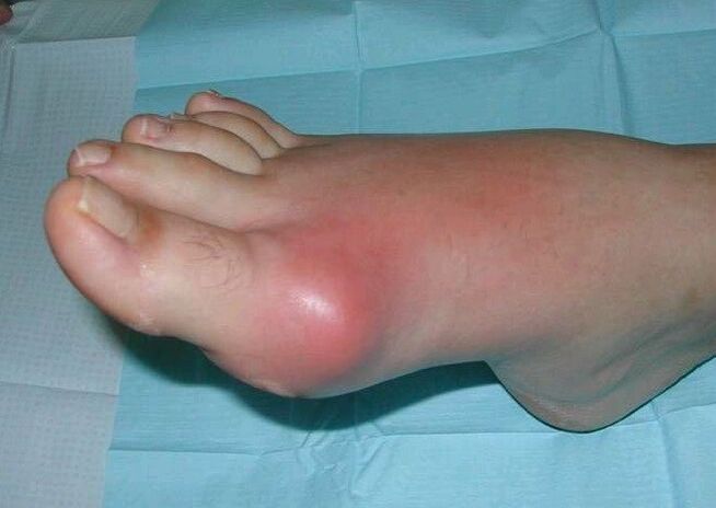 Клинична картина на артрит на ходилото - оток и възпаление