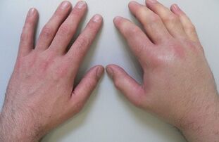 артралгия като причина за болка в ставите на пръстите