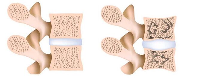 остеопороза - отстраняване на калций от костите