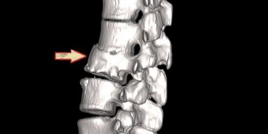 гръбначна патология като причина за болки в гърба