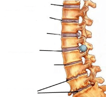 етапи на развитие на остеохондроза на гръбначния стълб