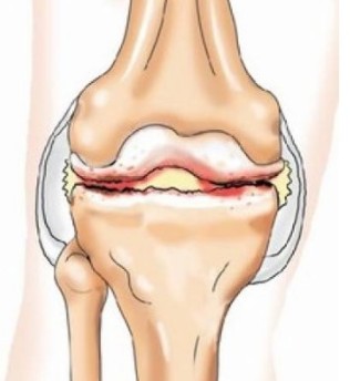 Воспалениие на сухожилията на коляното