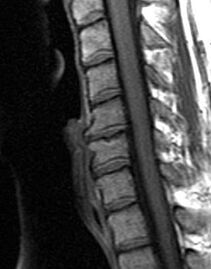 рентгенография на гръден отдел на гръбначния стълб