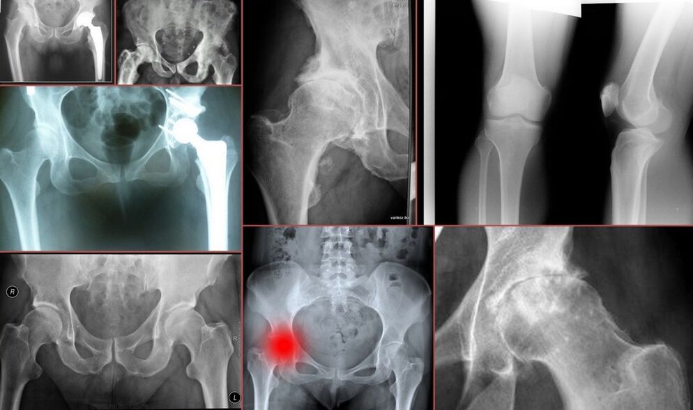 Рентгенова снимка за болки в тазобедрената става