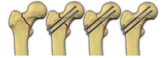 фиксиране на костното тяло с щифтове за болка в тазобедрената става
