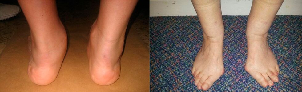 Артроза на палеца на крака и деформираща артроза на глезена