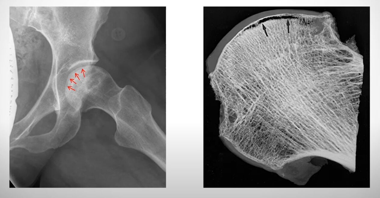 Рентгенова снимка на главата на бедрената кост, засегната от асептична некроза